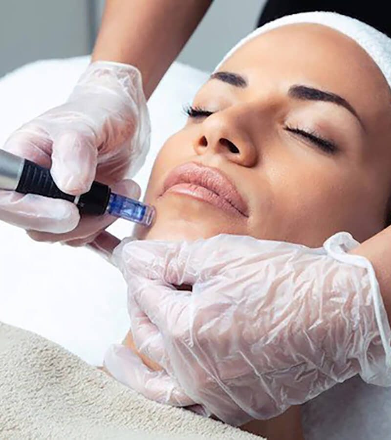 a woman getting microneedling a woman getting microneedling